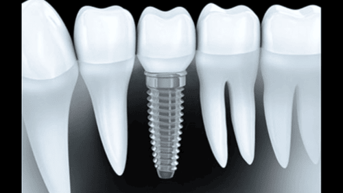 3D illustration of a dental implant with titanium screw and crown between natural teeth